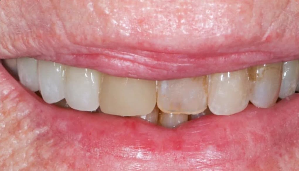 Patient case 01 before veneers