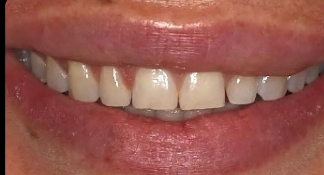 Patient case 02 before veneers