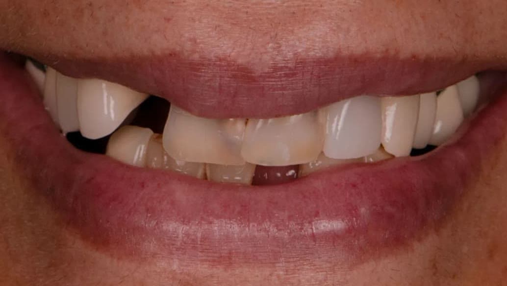 Patient case 03 before veneers